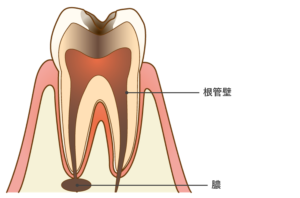根尖性歯周炎