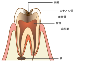 根尖性歯周組織炎