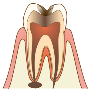 歯周病（膿が溜まった状態）
