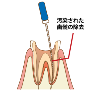 歯根の治療手順