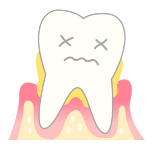 歯周病のメカニズム（重症）