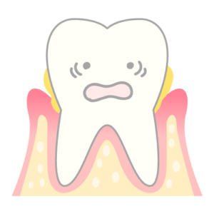 歯周病のメカニズム（骨が溶けている）