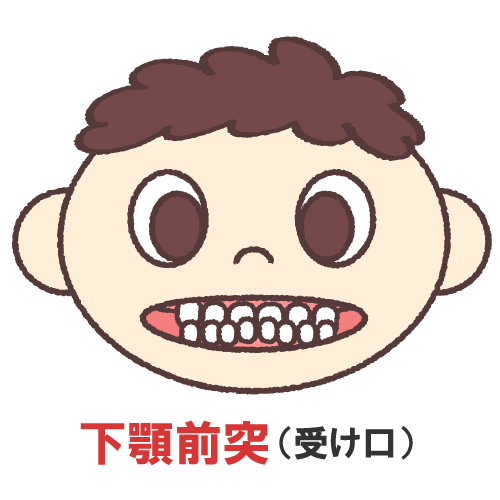 鳥取市 歯医者さん 小児歯科 不正咬合 下顎前突