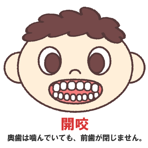 鳥取市 歯医者さん 小児歯科 不正咬合 開咬