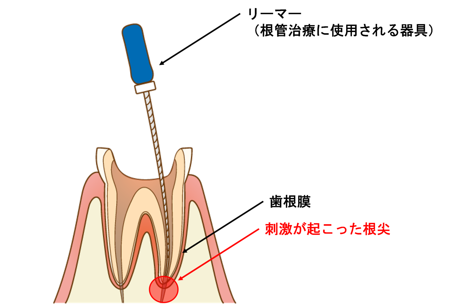根管治療はどのように行われるのですか?