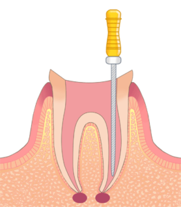 鳥取市　歯医者　虫歯　歯周病　根管　根管治療