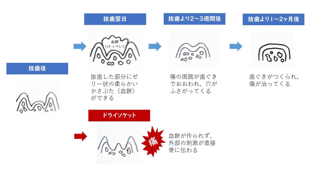 鳥取市 歯医者 ドライソケット 虫歯 虫歯治療