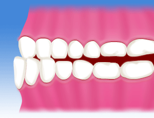 鳥取市　歯医者　虫歯　歯肉炎　矯正　小児矯正　上顎前突　出っ歯
