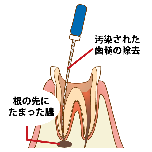 歯医者さん 虫歯 腫れる