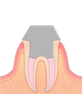 歯医者　歯根端切除術　むし歯