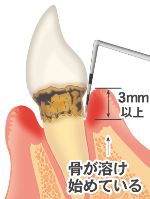 虫歯　歯周病　歯医者