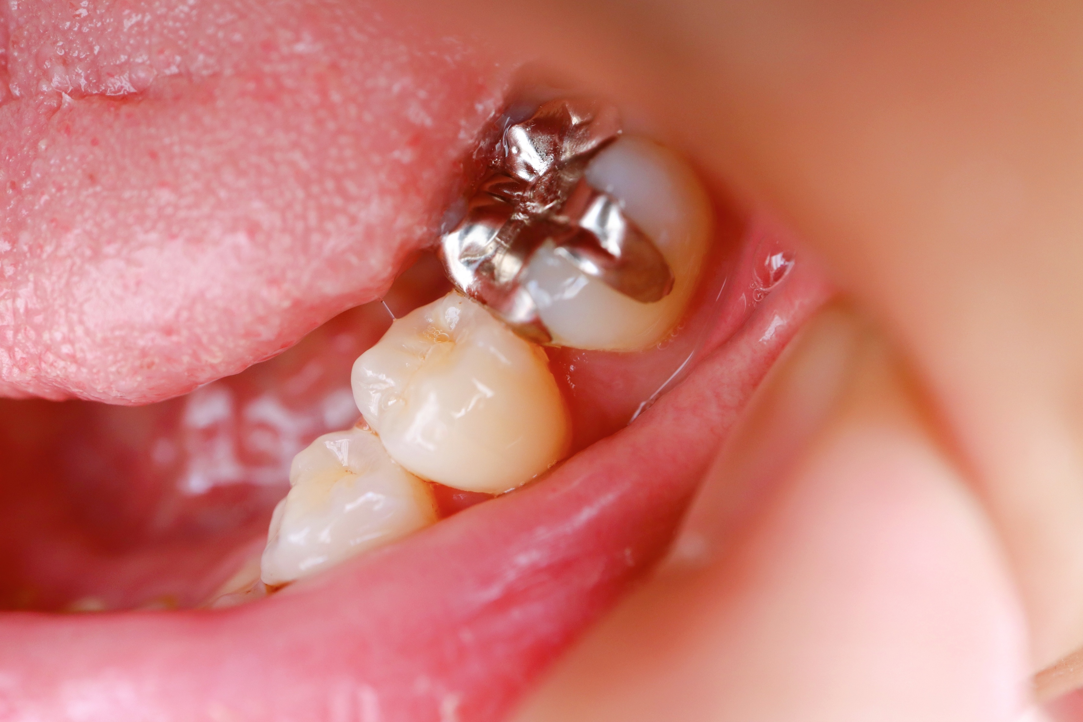 歯の被せ物の種類と選び方、治療の流れを解説！