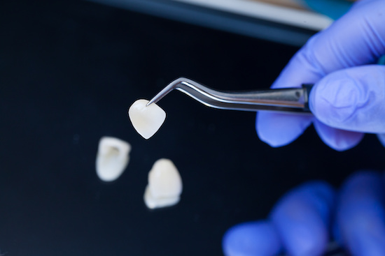 歯と歯の間の隙間を埋める場合のセラミックの治療法イメージ