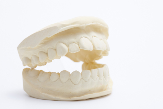 前歯を被せ物にする際に作成する模型