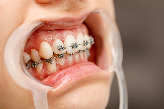 ワイヤーを使用した部分矯正