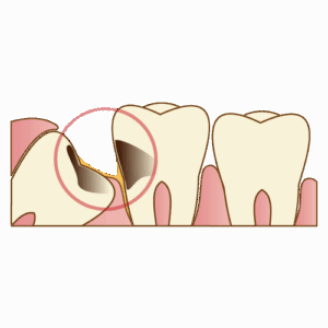 鳥取市 歯医者 親知らず