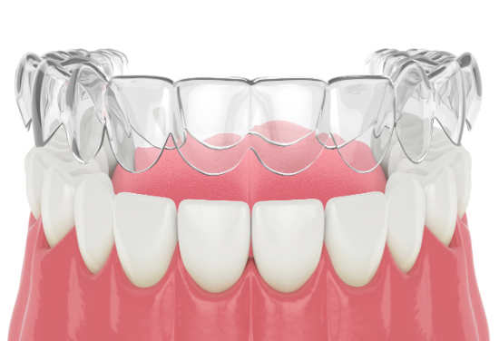マウスピース矯正を終えアライナーを外し後戻りがおこる様子