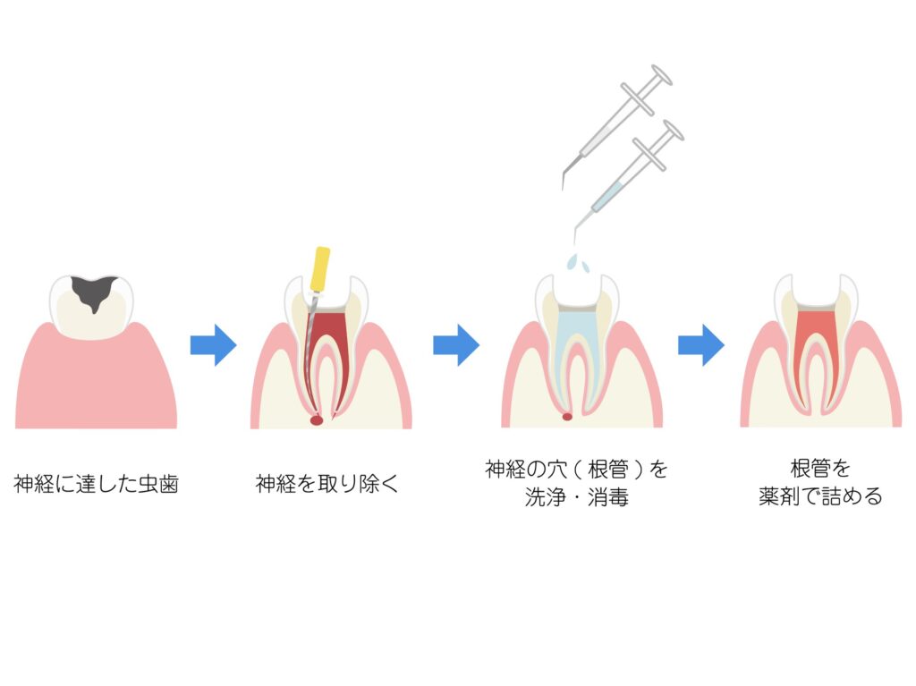根管治療
