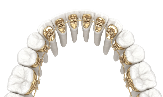 裏側矯正のイメージ