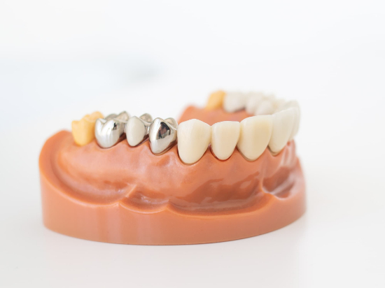 銀歯やセラミックなど様々な種類の被せ物の歯科模型