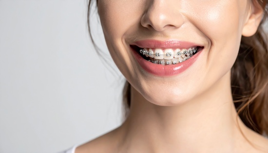 ワイヤー矯正をしている女性