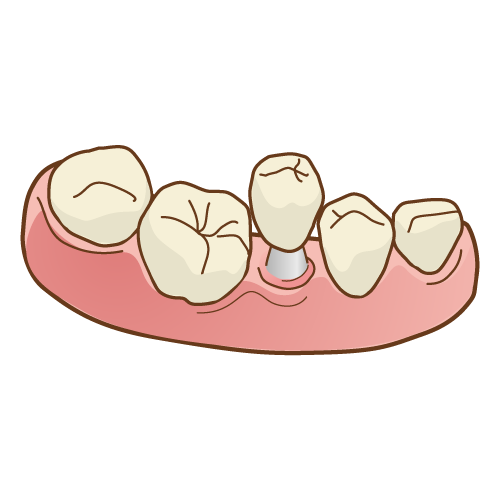 真っ直ぐに戻してから補綴物を入れる