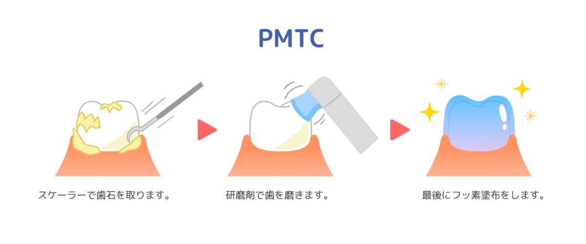 PMTCとは？