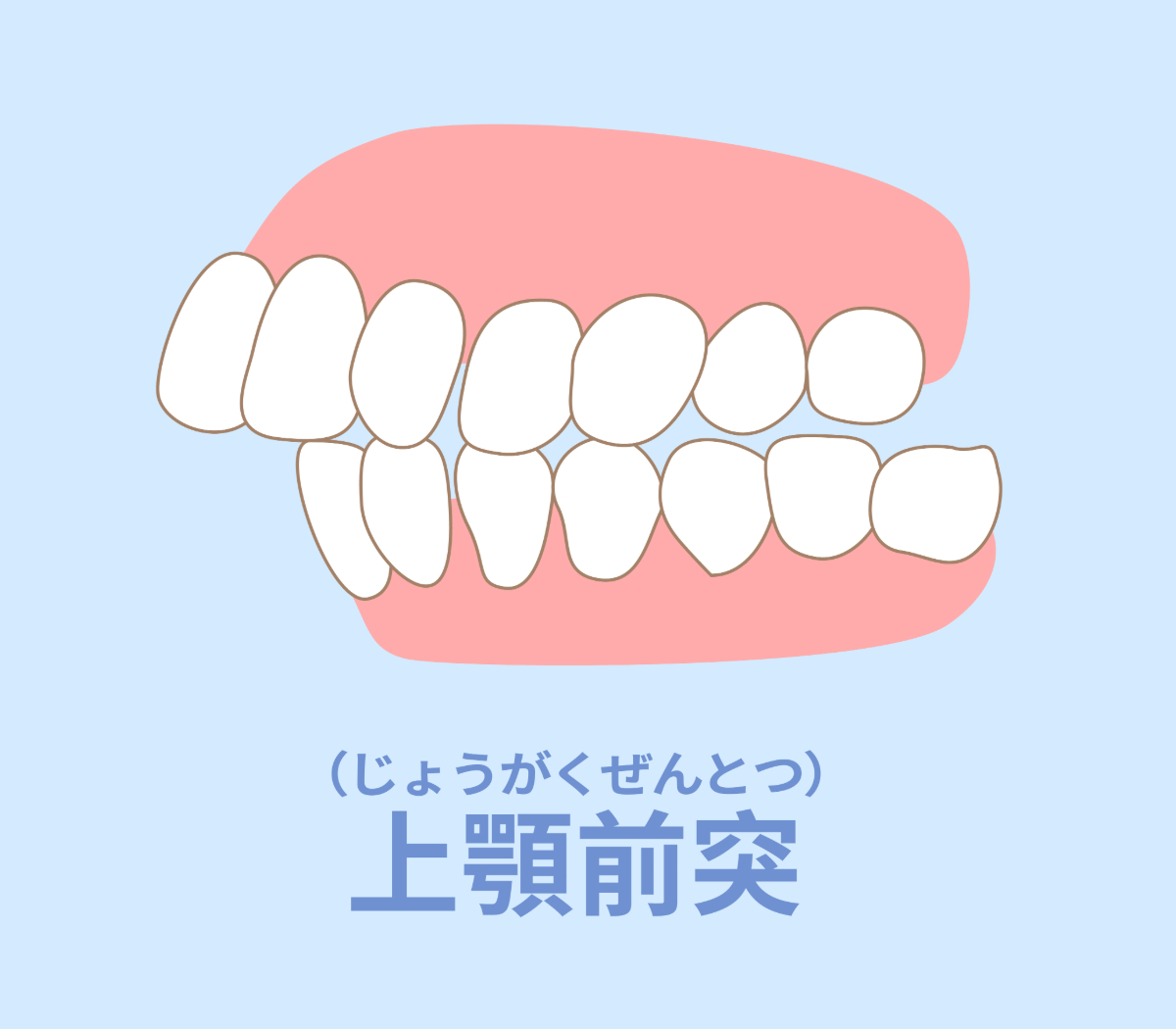 不正咬合の構造